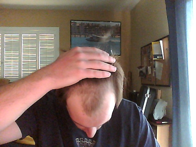 Finasteride