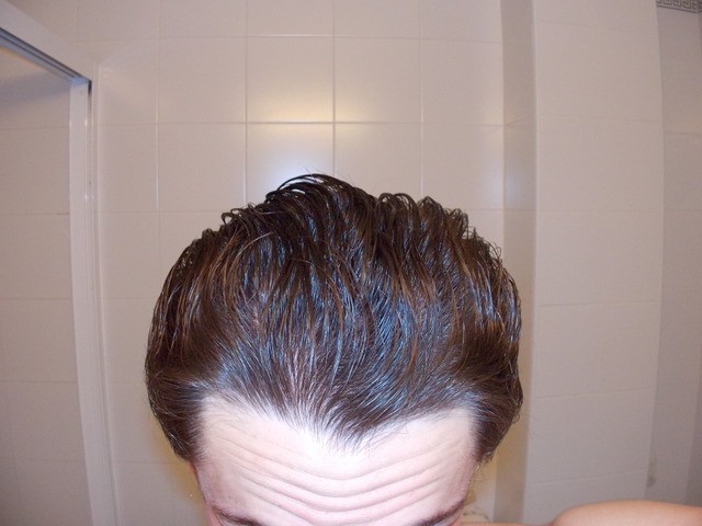 Finasteride